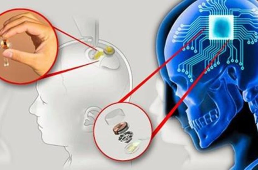  O que podem fazer “chips” implantados no cérebro humano